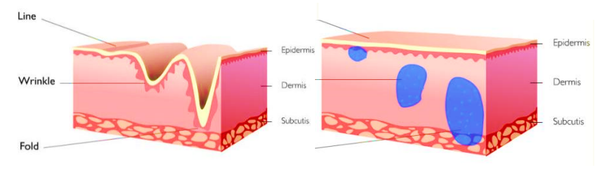Illustration showing how dermal fillers add volume beneath the skin to smooth wrinkles and restore facial contours